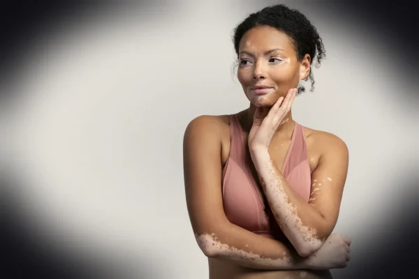 A woman with vitiligo is posing for a portrait.