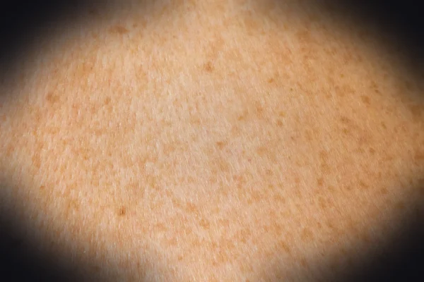 a close up of a person's back with brown spots