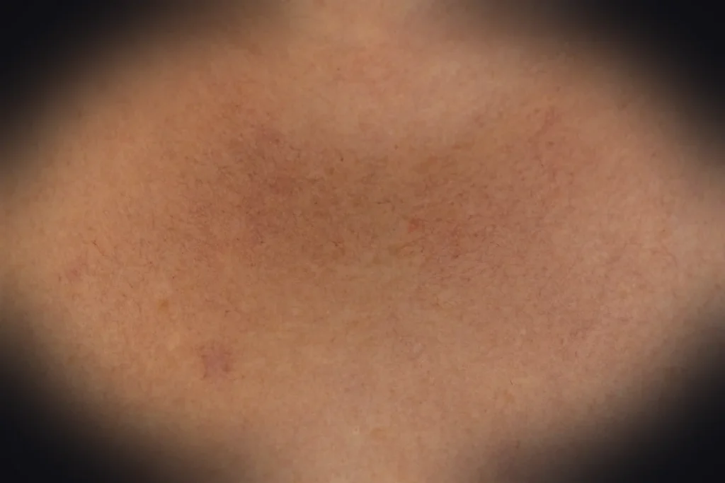 a close up of a person's back with acne on it