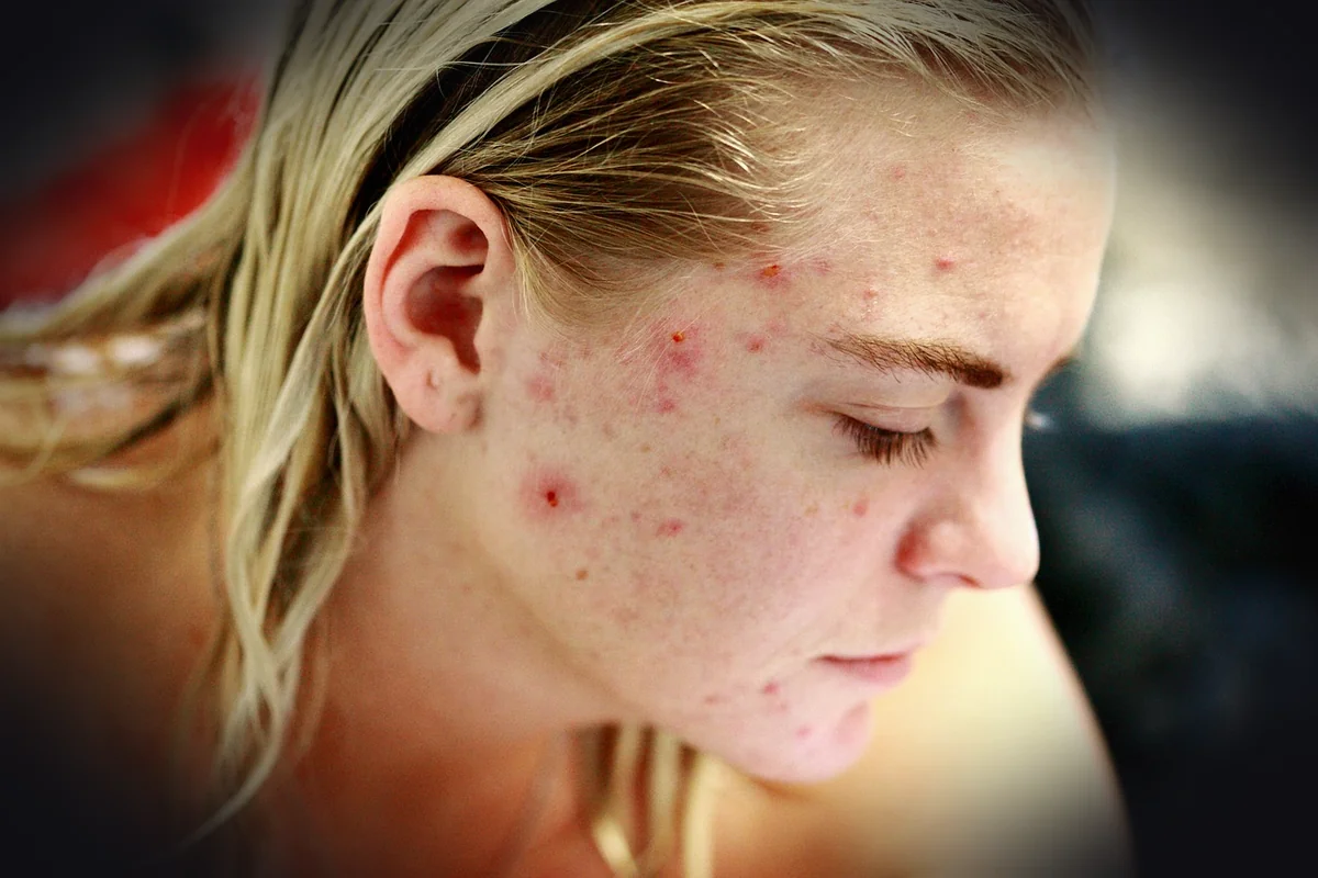 struggle, acne, self love, skin, face, portrait, woman, people, reality, girl, female, model, hair, person, human, skincare, 