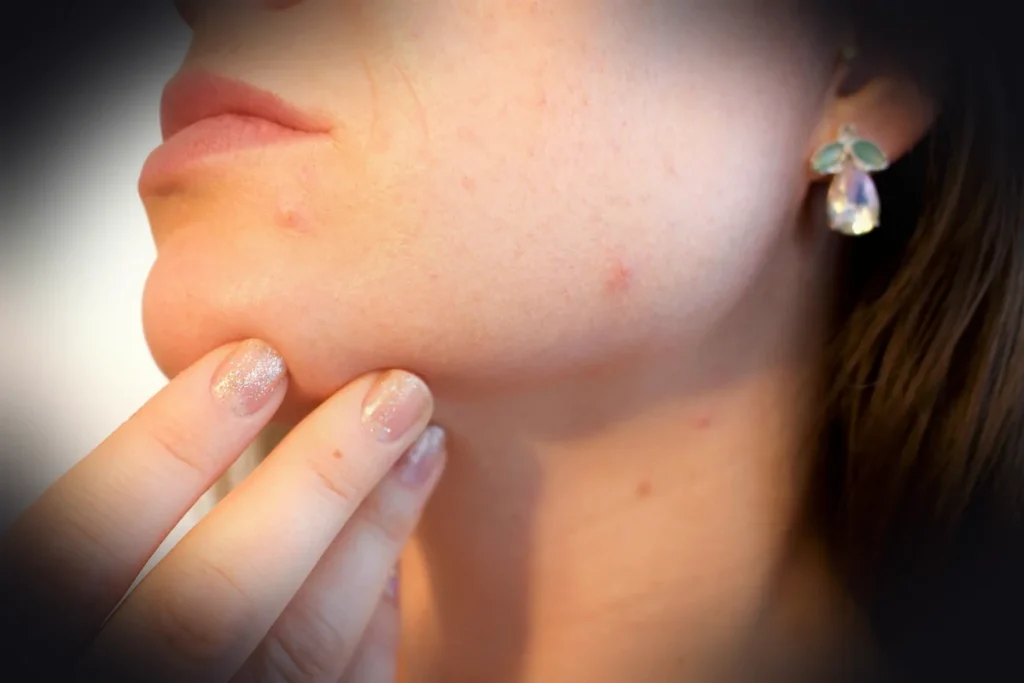 acne, pores, skin, pimple, female, face, skincare, infection, treatment, disease, dermatology, facial, person, hygiene, painf