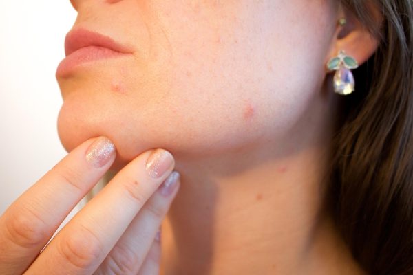 Spironolactone adult acne dermatologist conversation