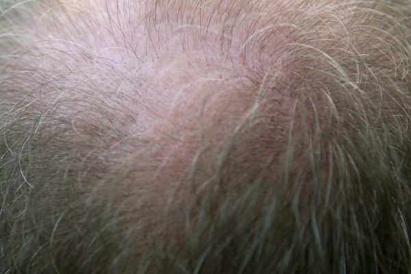 Tinea versicolor vs hyperpigmentation